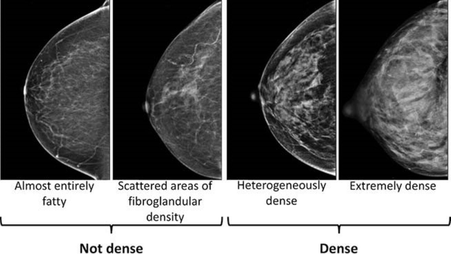 dense-breasts-can-make-it-harder-to-spot-cancer-on-a-mammogram