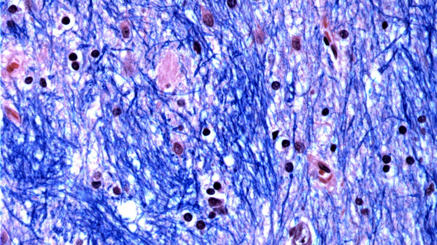 surprise-finding-sheds-light-on-what-causes-huntington’s-disease,-a-devastating-fatal-brain-disorder