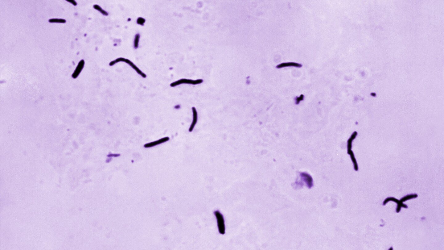 brote-de-tuberculosis-en-kansas-es-alarmante,-pero-no-es-el-mayor-de-eeuu,-dicen-los-cdc