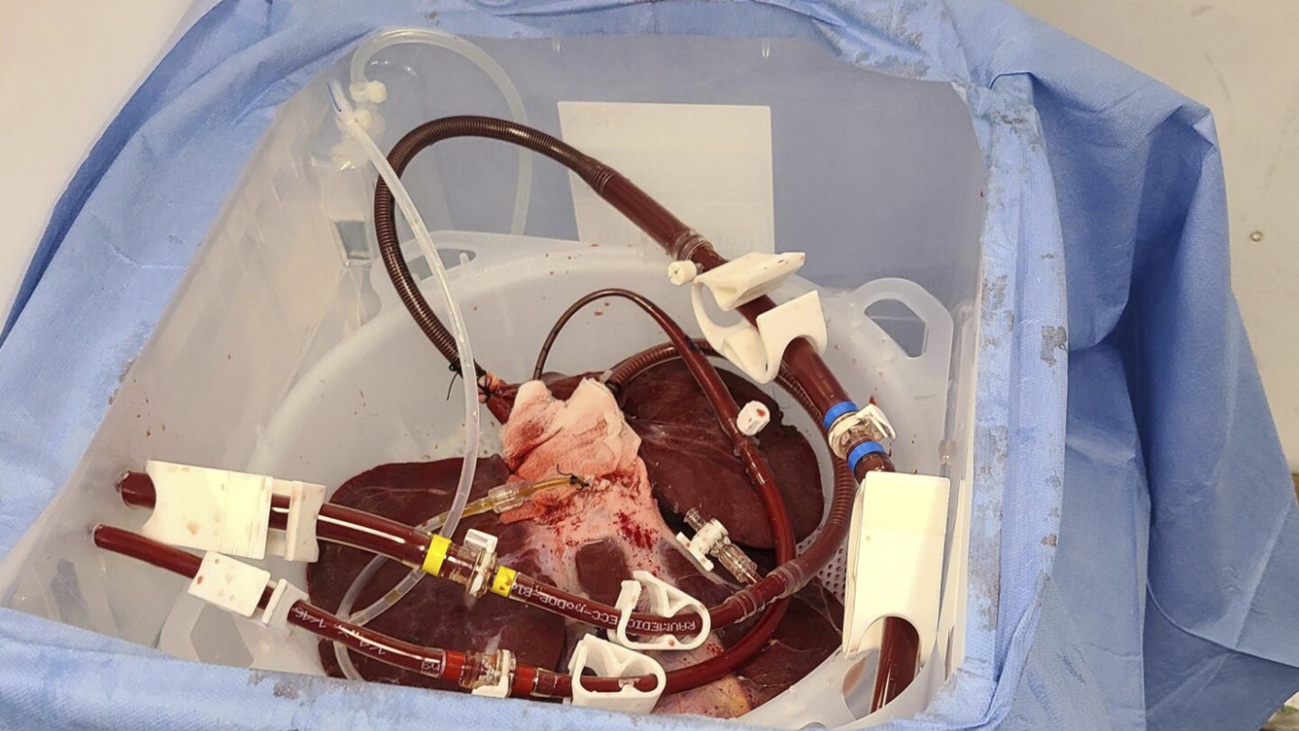 fda-oks-trial-of-pig-livers-as-dialysis-like-treatment-for-liver-failure