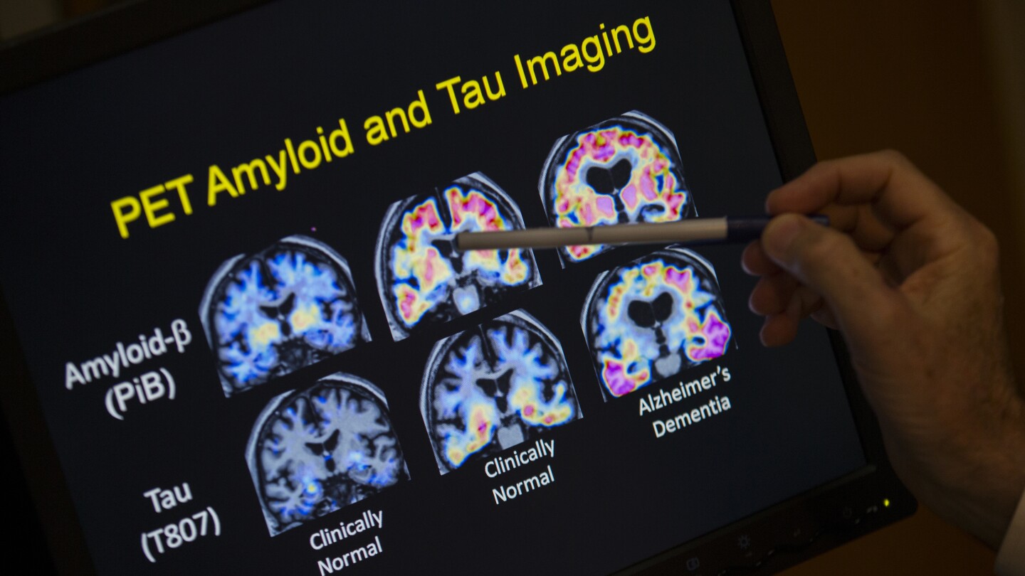fda-oks-first-blood-test-that-can-help-diagnose-alzheimer’s-disease