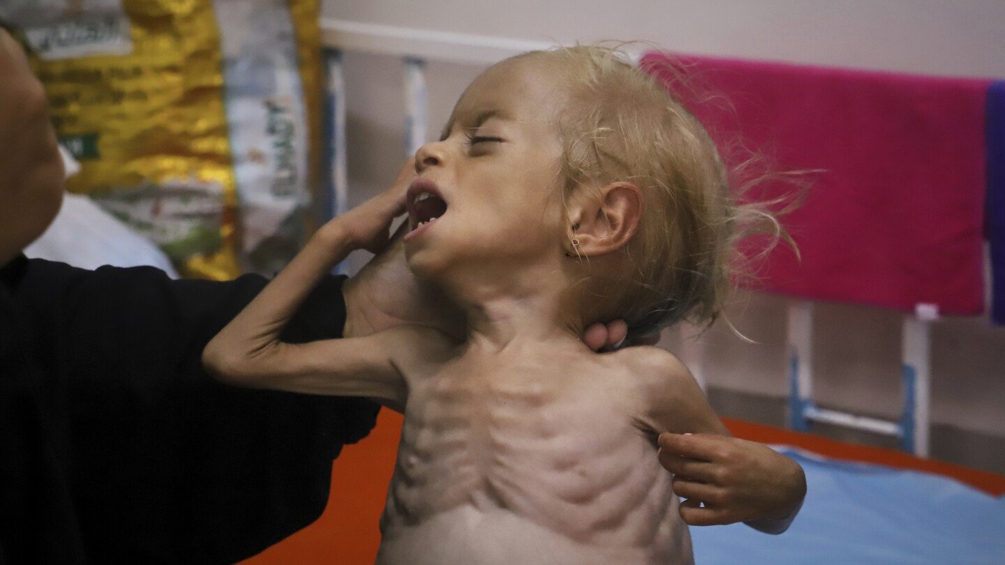 malnourished-kids-arrive-daily-at-a-gaza-hospital-as-netanyahu-denies-hunger