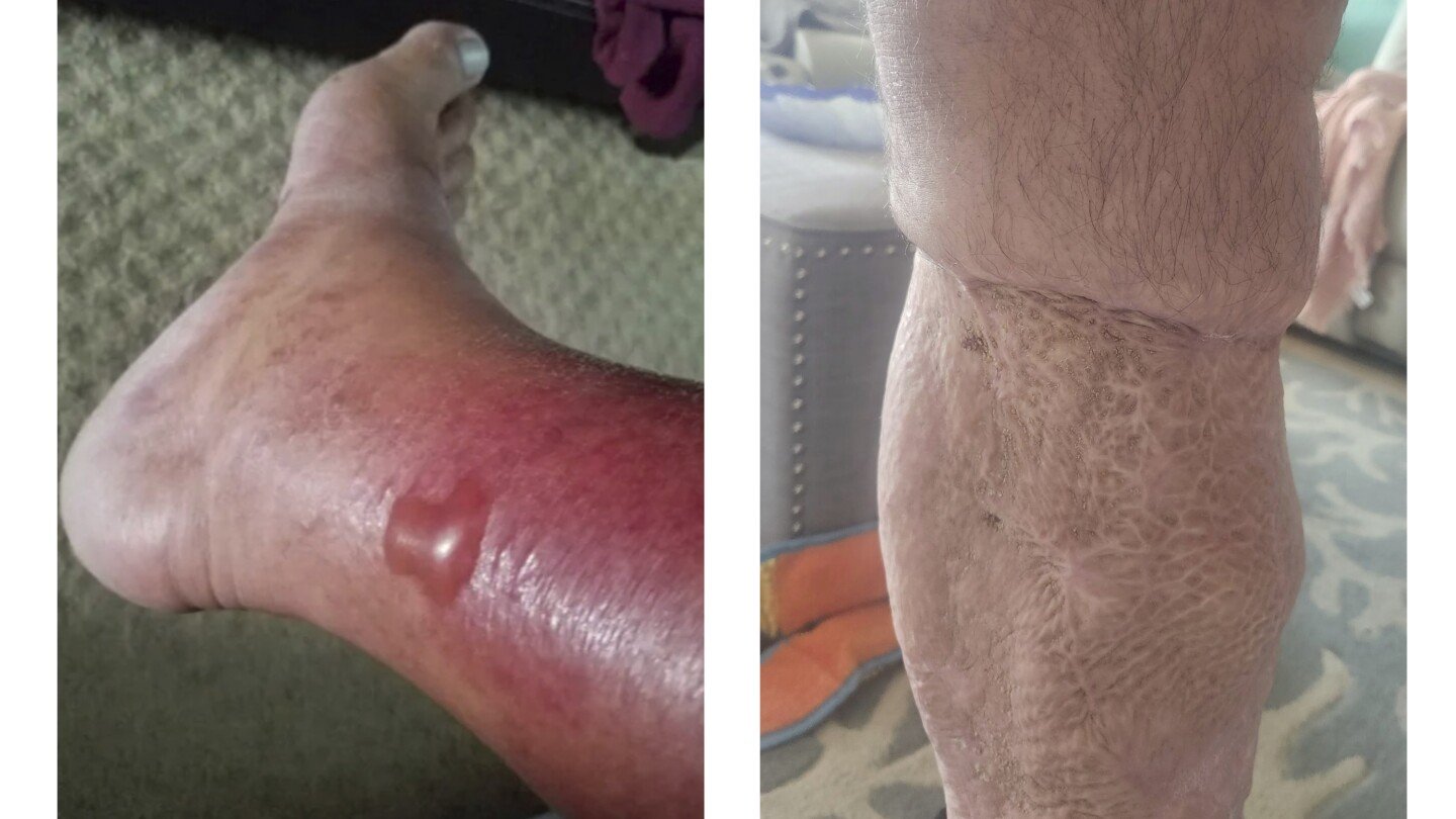 how-to-protect-yourself-from-vibrio-vulnificus,-the-bacteria-found-in-some-coastal-waters