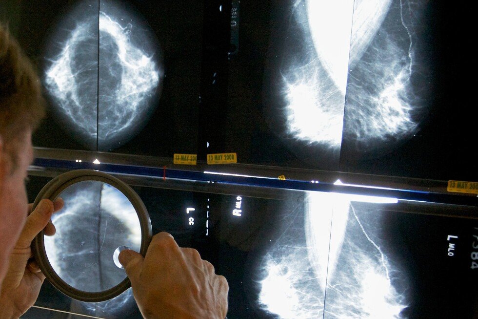 conflicting-advice-makes-it-hard-to-know-when-to-get-a-mammogram