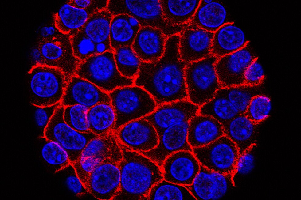 daraxonrasib-vs.-pancreatic-cancer:-experimental-pill-helped-people-live-longer