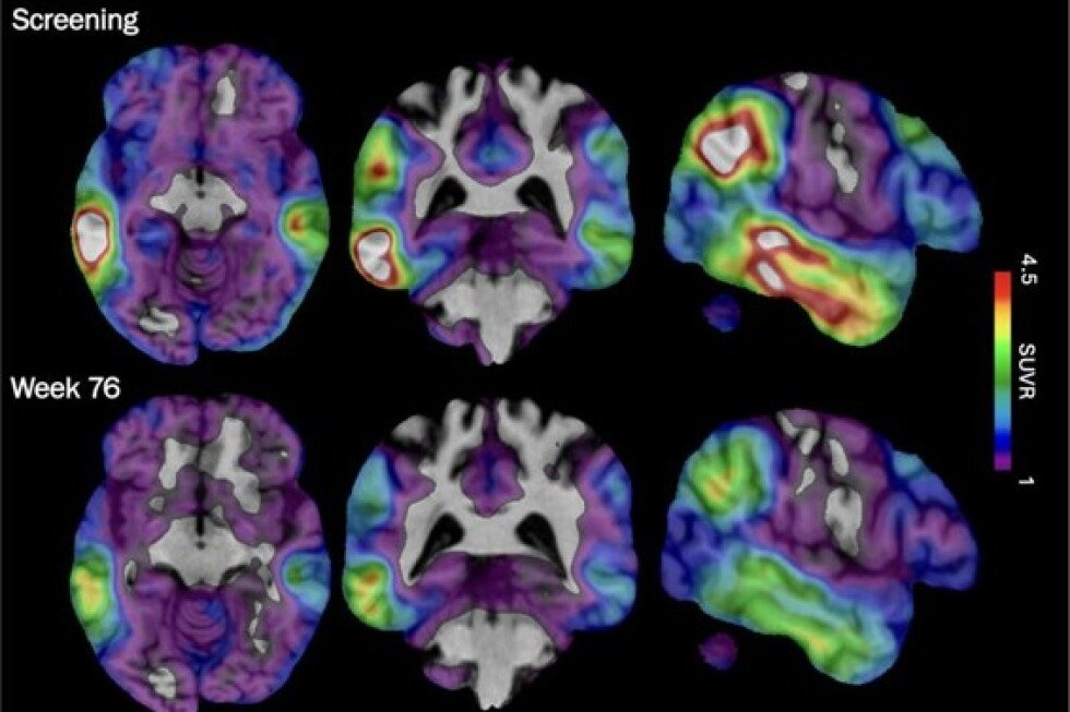 biogen’s-experimental-alzheimer’s-drug-targets-tau-protein